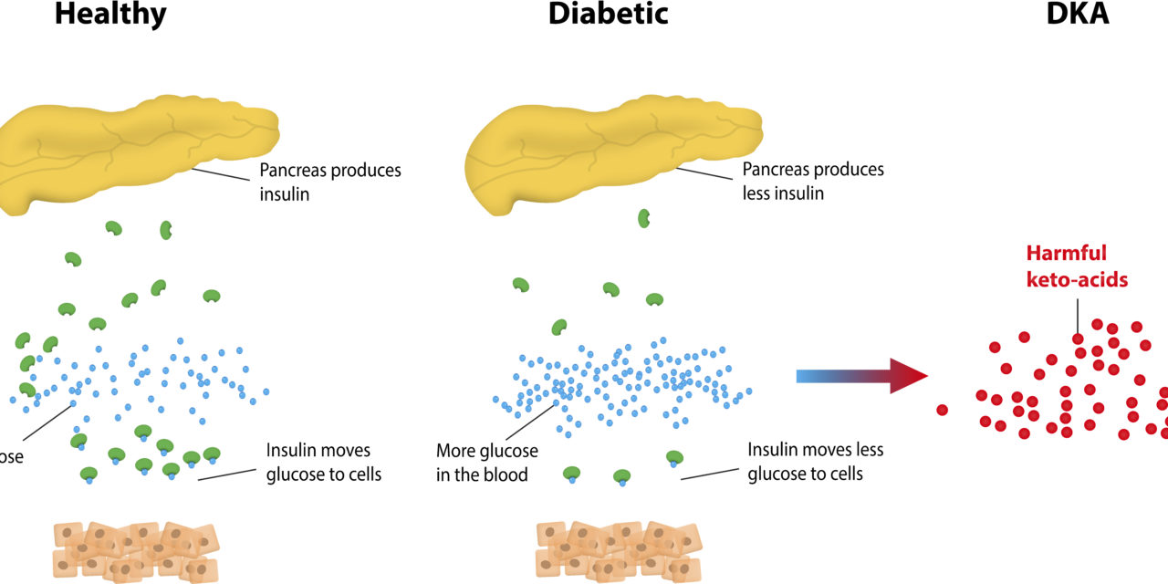 Making Sense of Ketones with Diabetes