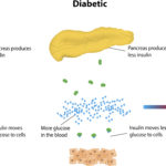 Diabetic Ketoacidosis