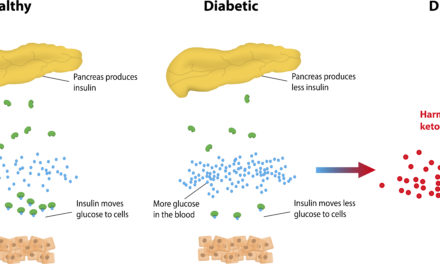 Diabetic Ketoacidosis